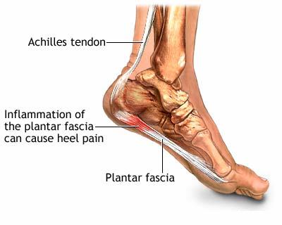 Plantar fasciitis