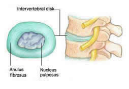 Herniated disk--Beverly Hills Chiropractic
