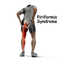 Piriformis Syndrome--West Hollywood Chiropractor