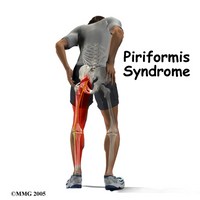 West Hollywood Chiropractor--piriformis syndrome