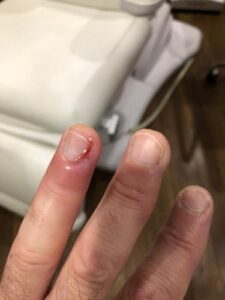 infected finger - paronychia